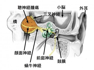 聴神経腫瘍と骨伝導イヤホン
